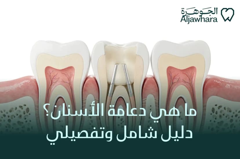 ما هي دعامة الأسنان؟