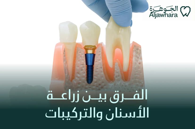 الفرق بين زراعة الأسنان والتركيبات