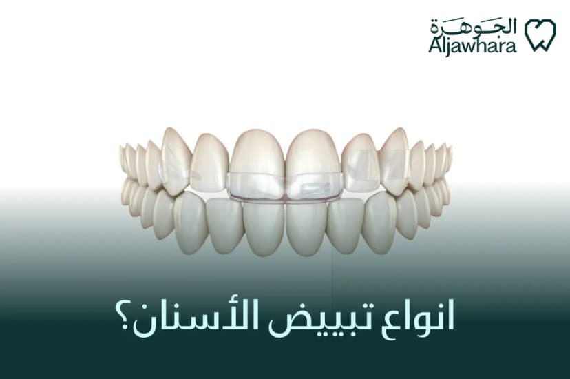 انواع تبييض الأسنان