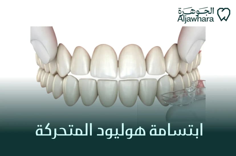 ابتسامة هوليود المتحركة 
