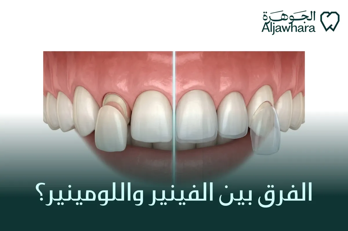 الفرق بين الفينير واللومينير