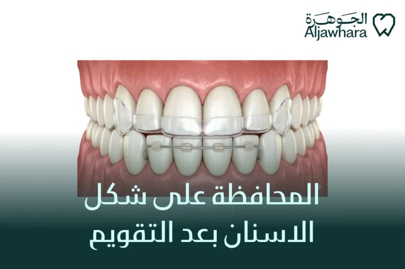 المحافظة على شكل الاسنان بعد التقويم