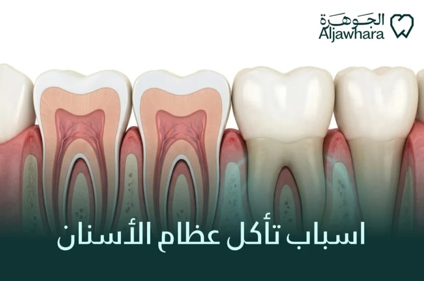 اسباب تأكل عظام الأسنان