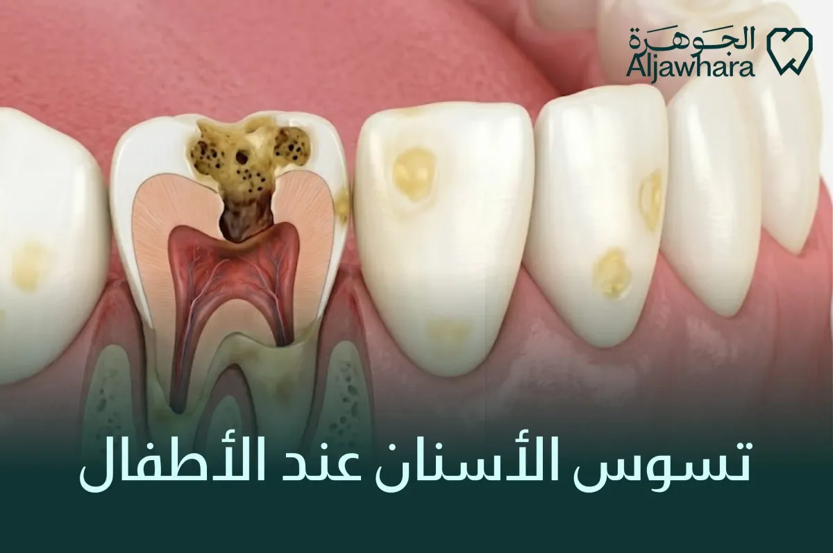 تسوس الأسنان عند الأطفال