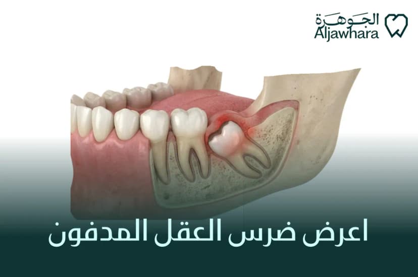 اعرض ضرس العقل المدفون