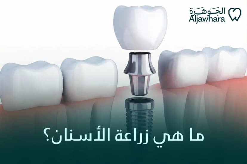 ما هي زراعة الأسنان؟