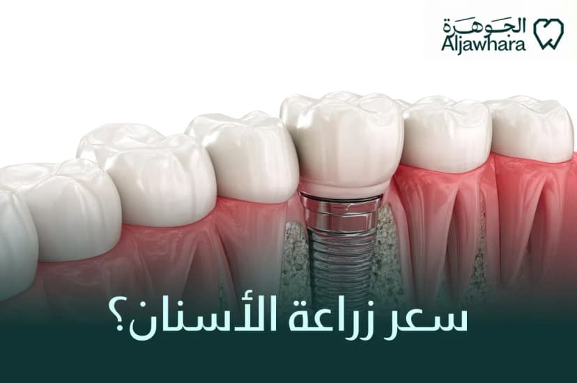 سعر زراعة الأسنان